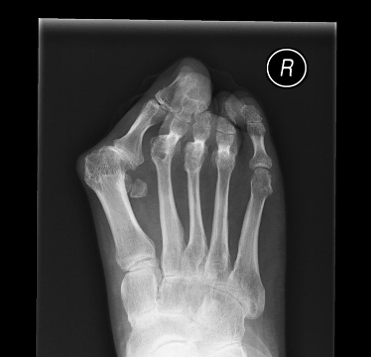 Rheumatoid Foot